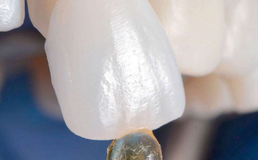 Эстетическая реставрация зубов винирами. Сделают ли Вашу улыбку красивой ровные белые зубы?