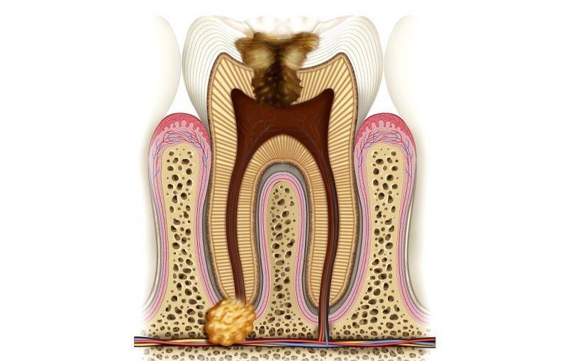 Живете с кистой и не знаете об этом? А чем гранулема и киста зуба опасны для Вашего здоровья?
