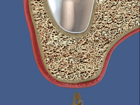 Синус-лифтинг и костная пластика при протезировании боковых зубов на верхней челюсти
