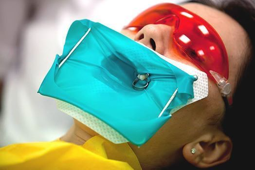 Использование коффердама для повышения качества лечения зубов и безопасности пациентов